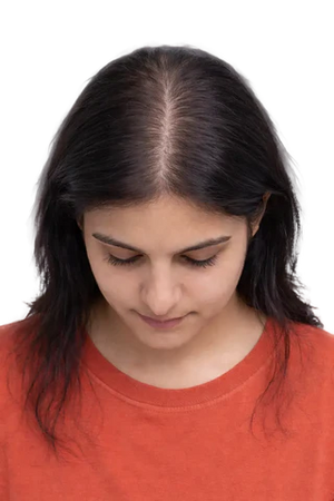 Overall thinning & volume loss