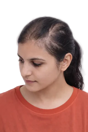 Thinning at front or sides