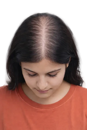 Wide partition; scalp slightly visible