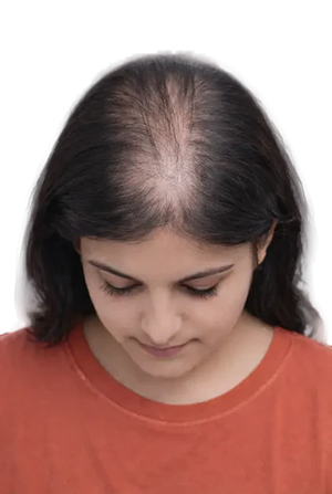 Wide partition; clear scalp visible