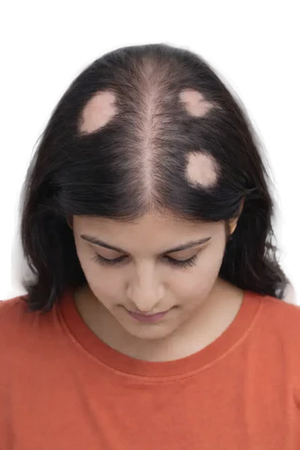 Visible coin-sized bald patches