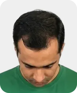 Stage 3
