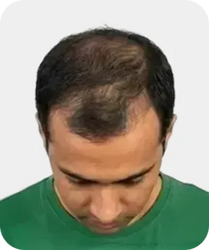 Stage 4